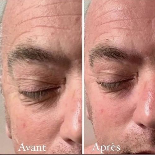 Séances Radiofréquence (visage et cou)