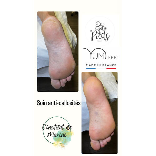 Soin anti-callosités Yumifeet